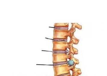 Četri osteohondrozes attīstības posmi